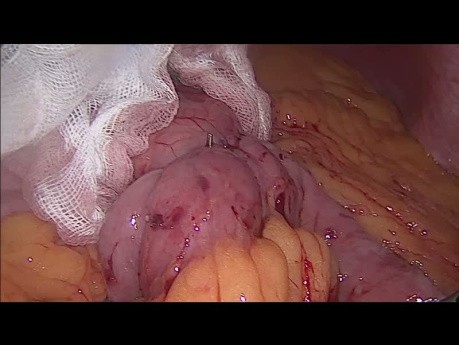 One Anastomosis Gastric Bypass Leak Test