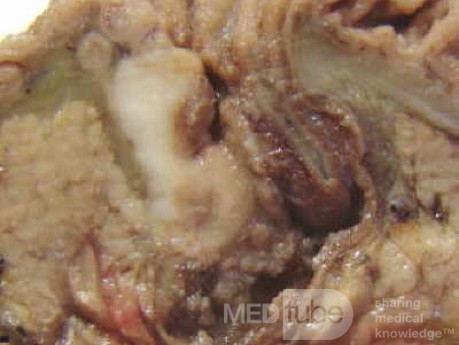 Cholangiocarcinoma that infiltrated a Periampullary Duodenal Diverticula and the head of the pancreas (9 of 20)