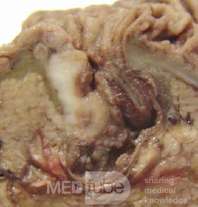 Cholangiocarcinoma that infiltrated a Periampullary Duodenal Diverticula and the head of the pancreas (9 of 20)