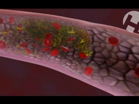 Myocardial Infarction