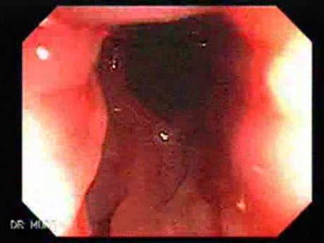 Adenocarcinoma and Hemorrhoids (2 of 2)