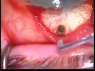 Glaucoma TCF, ABA Surgery with use Fugo Blade 
