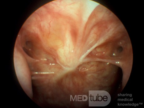 Prior Adenoidectomy