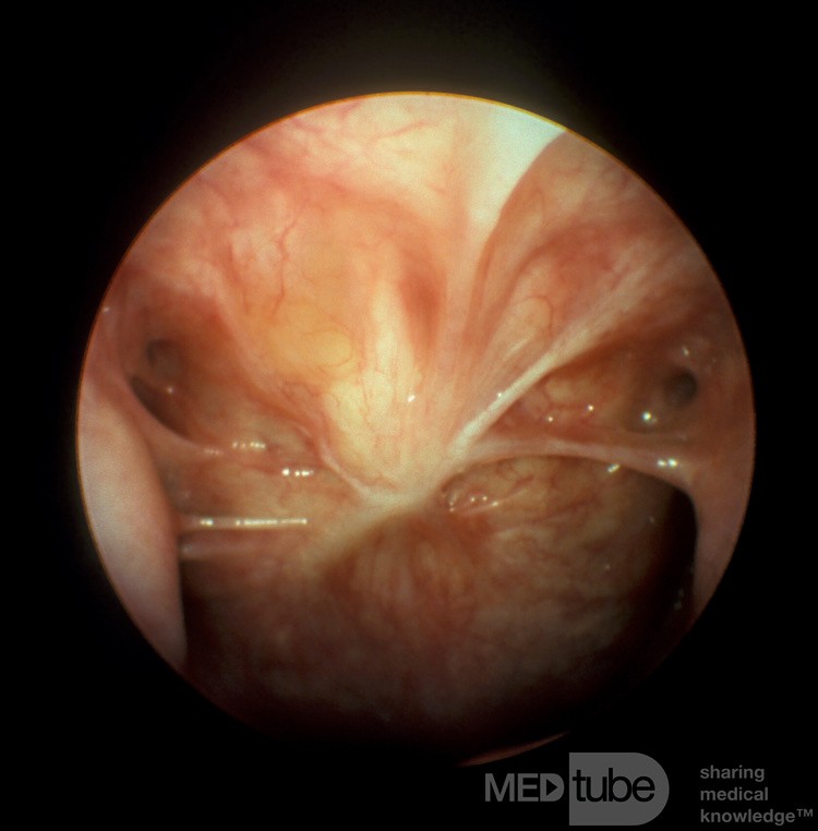 Prior Adenoidectomy