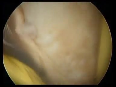 Hysteroscopic endometrial ablation and partial myometrectomy