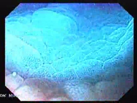 Gastric Folds - Immersion Endoscopy (7 of 8)