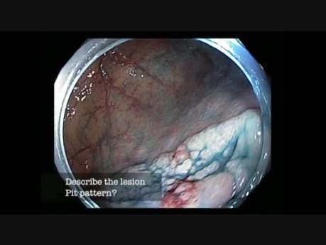 Colonoscopy Channel Quiz 19