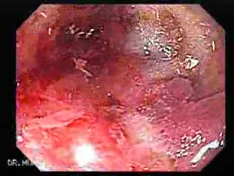 Magnification Endoscopy of Barrett's Tongue, Part 2