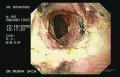 Zollinger- Ellison Syndrome - Gastric Ulcer with Gastrocolic Fistula (18 of 21)