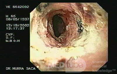 Zollinger- Ellison Syndrome - Gastric Ulcer with Gastrocolic Fistula (18 of 21)