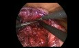 Gastric Pouch Confectioning in VBG Conversion to RYGB