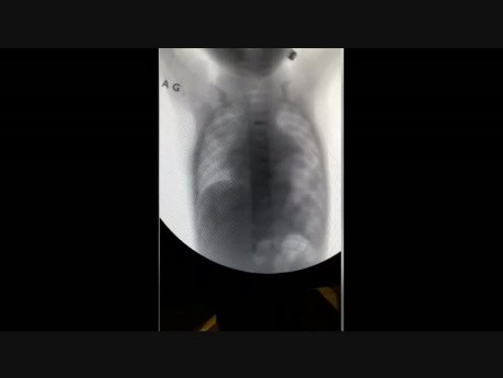 Paradoxical Movement of the Lt Diaphragm Due to its Palsy
