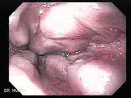 Hemorrhage After Ligation - 65 Years-Old Female