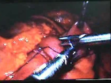 Jejunal Gastrointestinal Stromal tumor (GIST) (79 of 86)