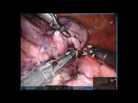 Left Upper Lobe Robotic Resection