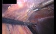Adhesive Complications in a Patient After Ventral Hernia IPOM Repair - Case 1 