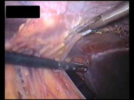 Adhesive Complications in a Patient After Ventral Hernia IPOM Repair - Case 1 
