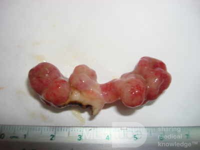 Colonoscopic Polypectomy (19 of 29)