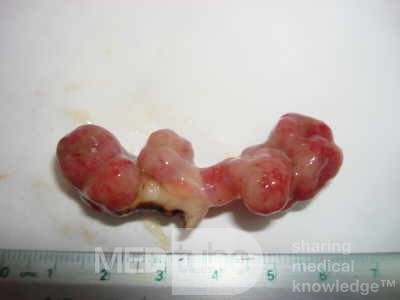 Colonoscopic Polypectomy (19 of 29)