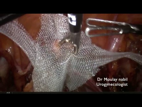 Pectopexy a Good Prolapse Surgery in an 80 Year Old Patient