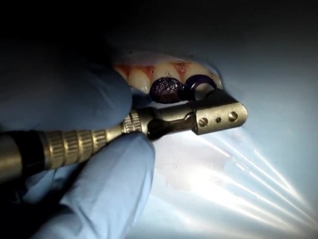 Tooth Stain Removal - Opalustre Part 2