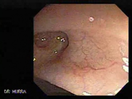 Colon Diverticula - Foot Steps Impression