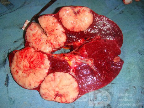 Non-Hodgkin's lymphoma of the spleen