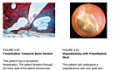 Diseases of the Ear - Volume 4 The Otic Capsule