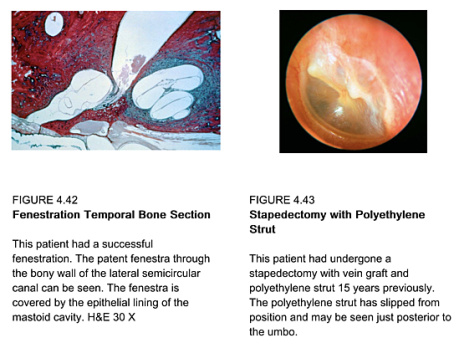 Diseases of the Ear - Volume 4 The Otic Capsule