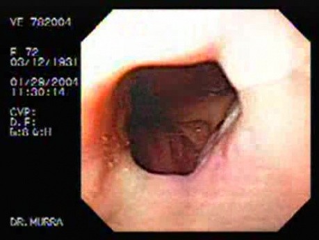 Mallory-Weiss Syndrome - Blood Clot and the Source of Bleeding