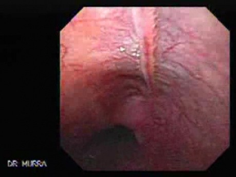 Esophageal Mucosal Bridge- Image of the Longitudinal Musocal Bridge