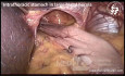 Intrathoracic Stomach in Large Hiatal Hernia