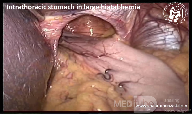 Intrathoracic Stomach in Large Hiatal Hernia