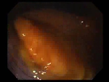 Gastrointestinal Stromal Tumor - GIST (40 of 65)