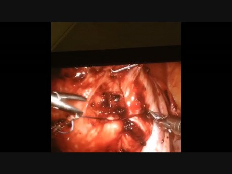 Robotic Myomectomy