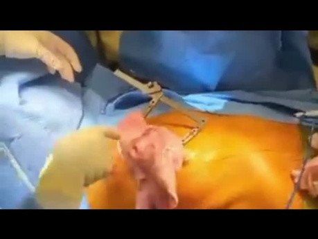 Minimally Invasive Lung Transplantation A to Z 