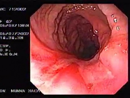 Crohn's Disease - Endoscopy (24 of 28)