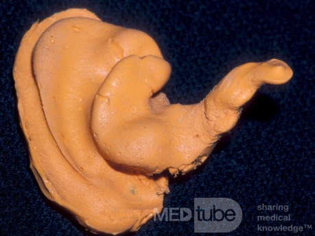Cast of the Conchal Bowl and Complete External Auditory Canal