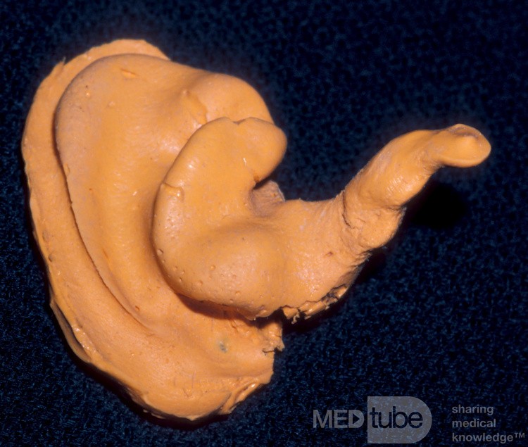 Cast of the Conchal Bowl and Complete External Auditory Canal
