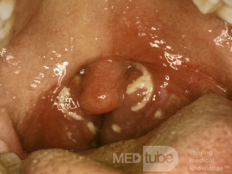 Mono Tonsillitis