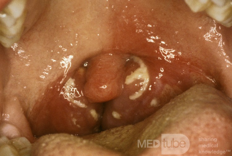 Mono Tonsillitis