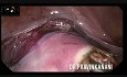 Cervical Fibroid