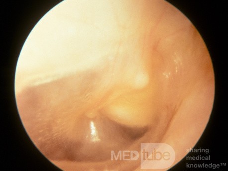 Congenital Cholesteatoma