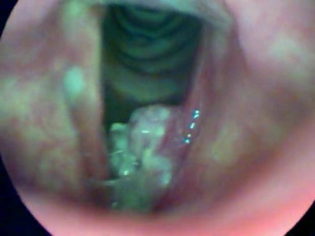 Laryngeal Cancer involving the left vocal fold and subglottis