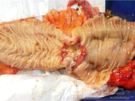 Cancer Sigmoid 