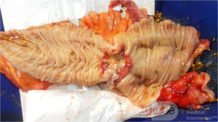 Cancer Sigmoid 