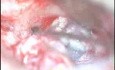 Cholesteatoma - Canal Up Mastoidectomy Incision - Part 2 - Sac Dissec