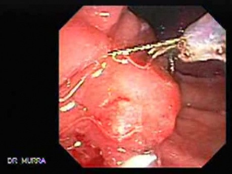 Adenocarcinoma of the Pancreas (3 of 8)