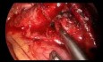 Minimally Invasive LT Pulmonary Artery Encircling and Release