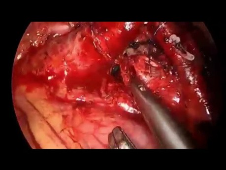 Minimally Invasive LT Pulmonary Artery Encircling and Release